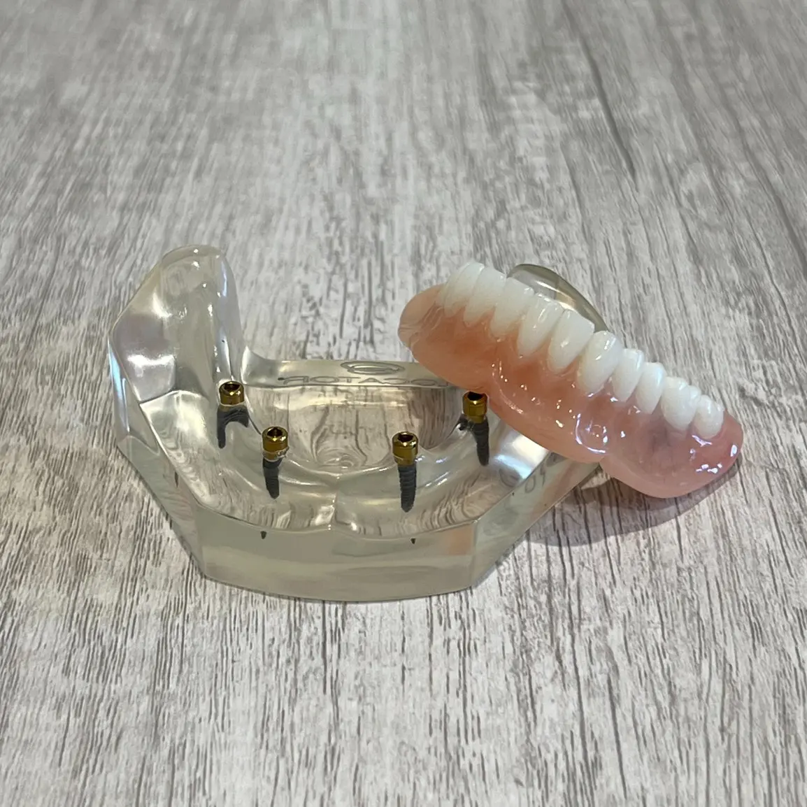 dental implants - snap in implant dentures