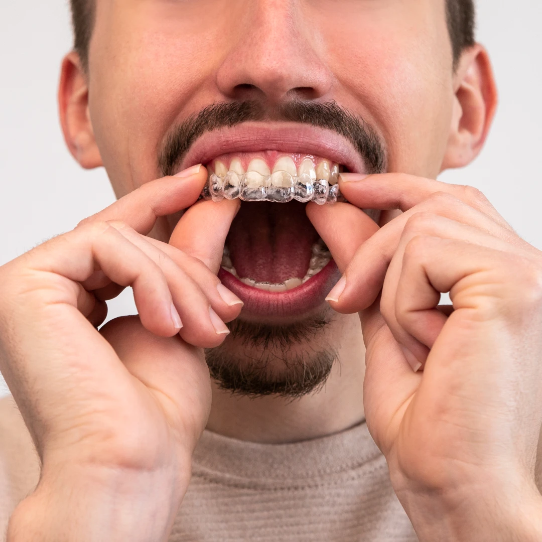 man putting on clear aligners