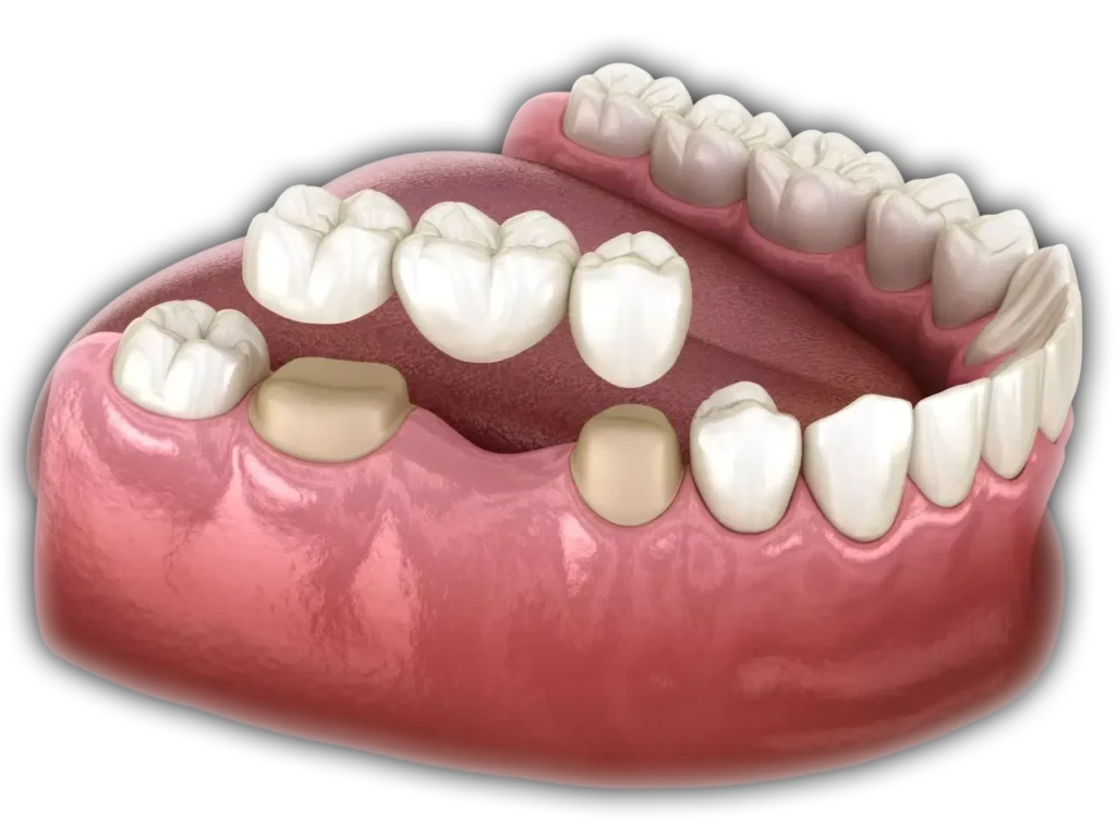 graphic of a porcelain dental bridge